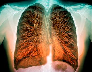 Μαγνητική τομογραφία στην διάγνωση του καρκίνου του πνεύμονα