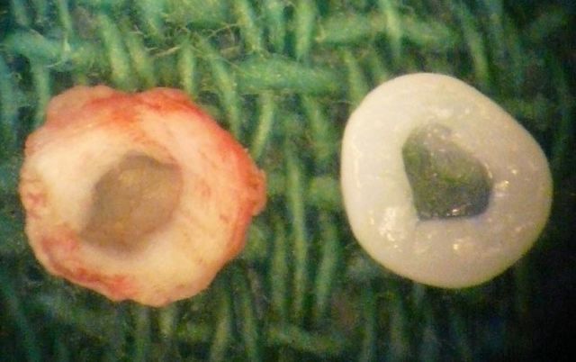 Καλλιεργημένοι μεσοσπονδύλιοι δίσκοι ίσως βάλουν τέλος στο λουμπάγκο