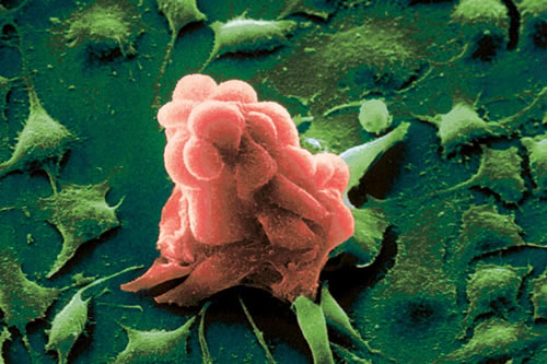 Τροποποιημένος ιός εξοντώνει τα καρκινικά κύτταρα, αφήνοντας ανέπαφους τους υγιείς ιστούς