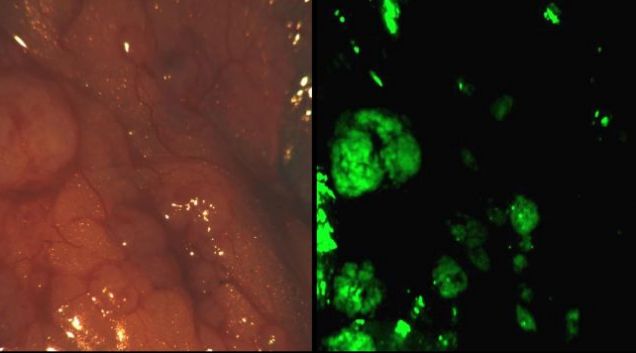Πιο στοχευμένη αφαίρεση των καρκινικών κυττάρων, υπόσχεται νέα τεχνική