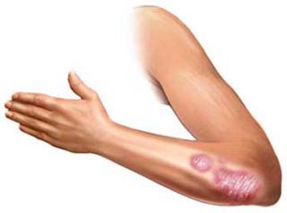 Κίνδυνος εγκεφαλικού επεισοδίου και καρδιακής αρρυθμίας για τους πάσχοντες από ψωρίαση