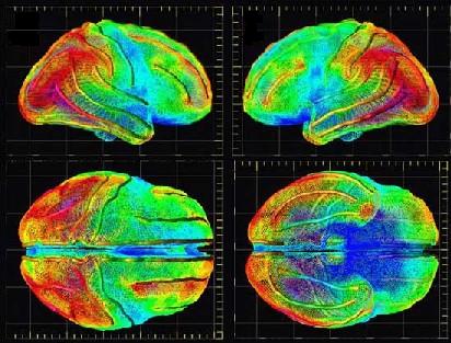 Κίνδυνος νόσου Αλτσχάιμερ για τα άτομα με υψηλή χοληστερόλη