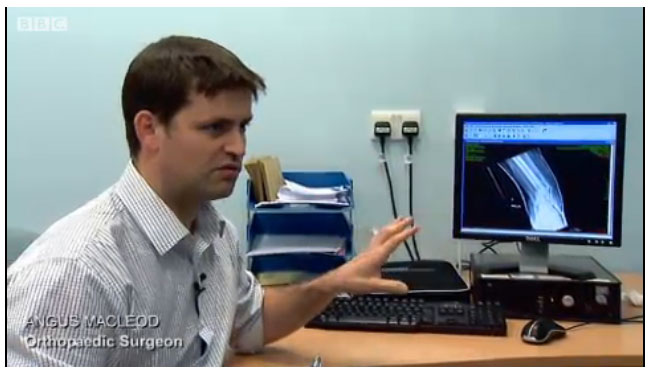 Αποκατάσταση καταγμάτων με υπερήχους εφαρμόζεται στο Βασιλικό Νοσοκομείο της Γλασκόβης