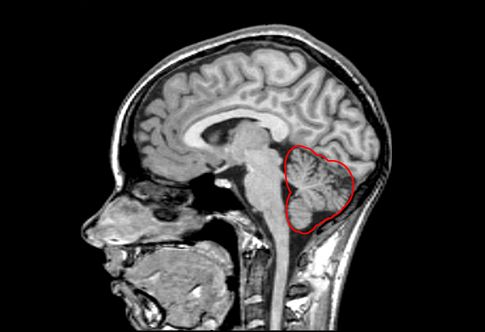 Ηλεκτρονική παρεγκεφαλίδα εμφυτεύεται σε παράλυτο πειραματόζωο