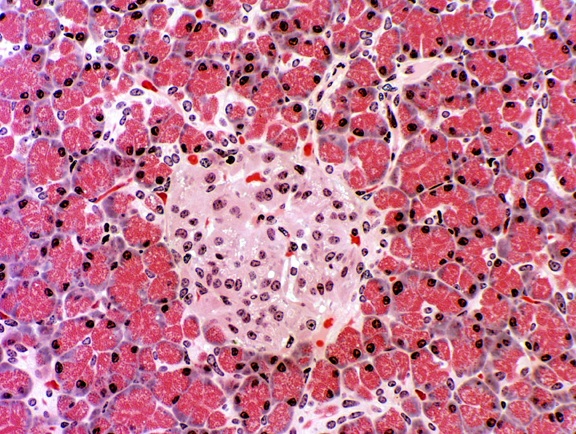 Διεθνής Ημερίδα για τη μεταμόσχευση νησιδίων παγκρέατος σε διαβητικούς ασθενείς