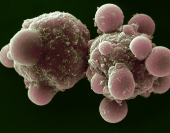 Θεραπεία της οξείας ηπατικής ανεπάρκειας σε βρέφος με μεταμόσχευση ηπατικών κυττάρων, πέτυχαν Βρετανοί γιατροί