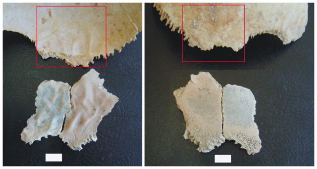 Ο άνθρωπος αγάπησε το κρέας από νωρίς, δείχνει προϊστορικό περιστατικό αναιμίας