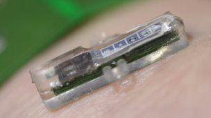 Υποδόριο τσιπ λειτουργεί ως διαγνωστικό εργαστήριο