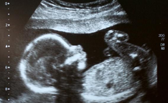 «Τα έμβρυα αυνανίζονται», το νέο επιχείρημα κατά των αμβλώσεων