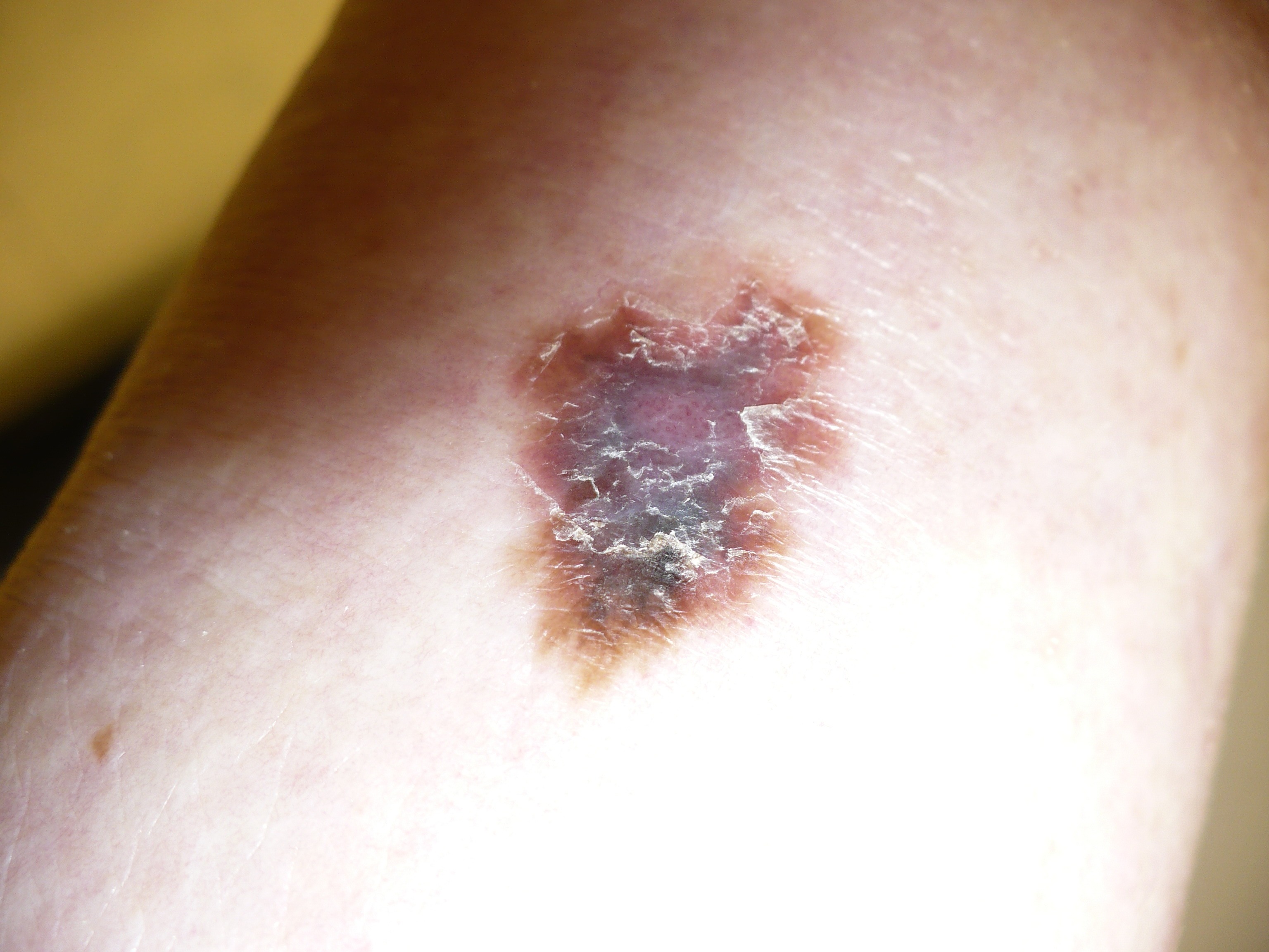 Φυσική ουσία αναστέλλει τη μετάσταση του μελανώματος