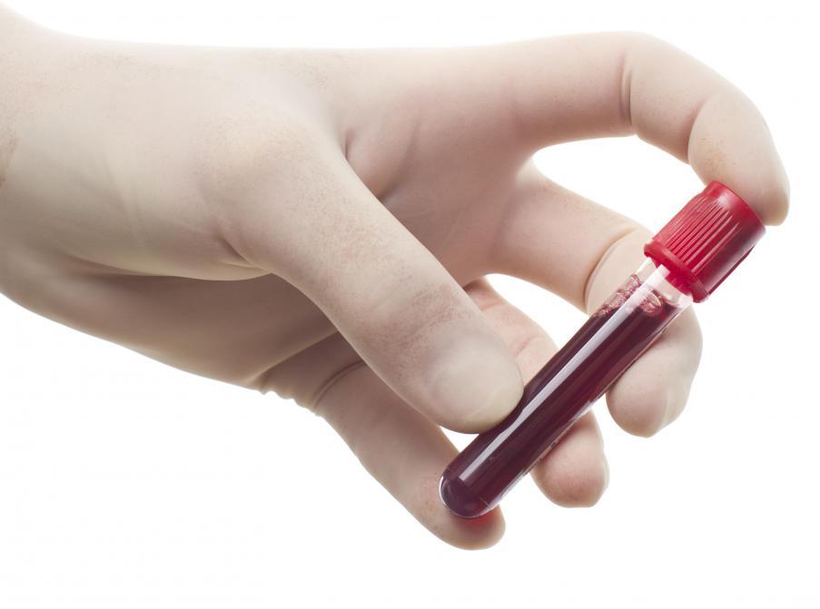 Το αυξημένο ουρικό οξύ μειώνει τον κίνδυνο νόσου Πάρκινσον