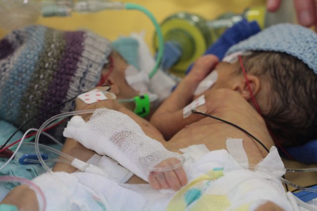 Ελβετία: Σιαμαία διαχωρίστηκαν μόλις οκτώ ημέρες μετά τη γέννησή τους