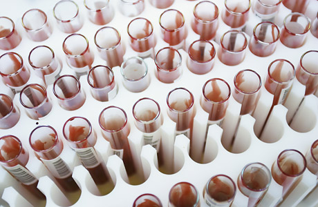 Νέο φάρμακο αλλάζει τη θεραπεία της αιμορροφιλίας Α