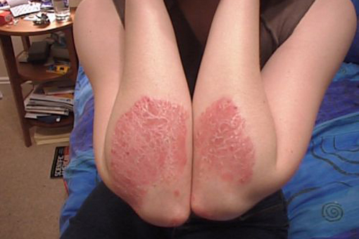 Σταθερά καθαρό δέρμα για τους ασθενείς με ψωρίαση με σεκουκινουμάμπη