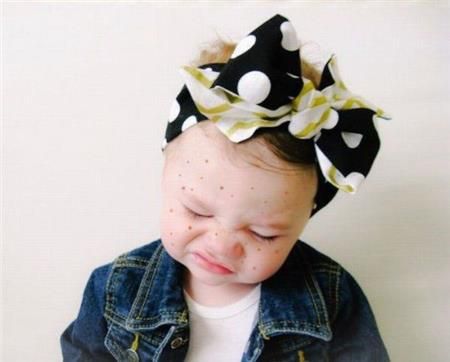 Έβγαλε εξάνθημα; Αντιμετωπίστε το!