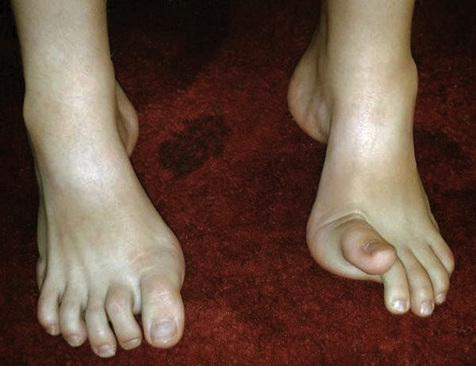 Νέα γονιδιακή θεραπεία για κληρονομικές περιφερικές νευροπάθειες