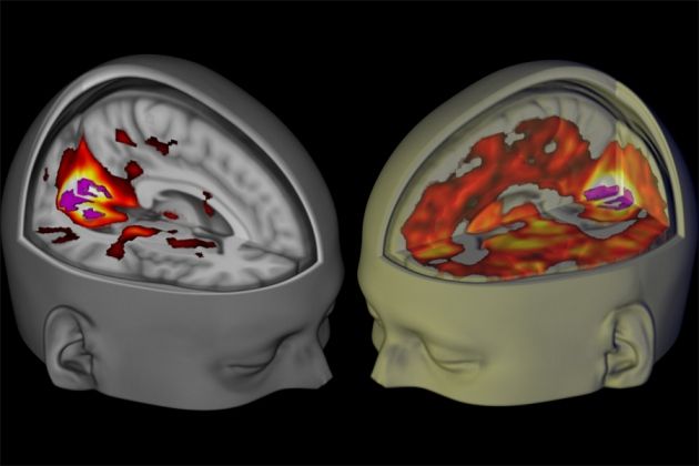 Τομογραφίες αποκαλύπτουν την επίδραση του LSD στη συνείδηση