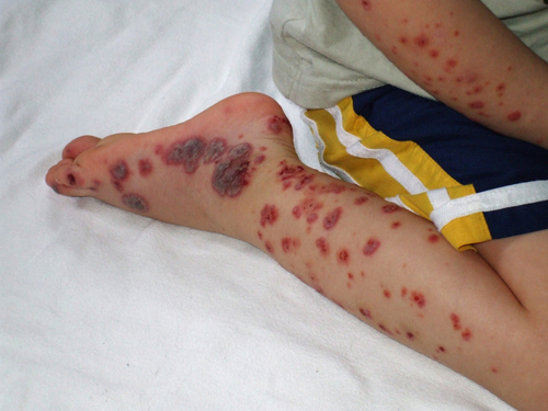 ΕΕ: Νέα θεραπεία για την ιδιοπαθή θρομβοπενική πορφύρα σε παιδιά