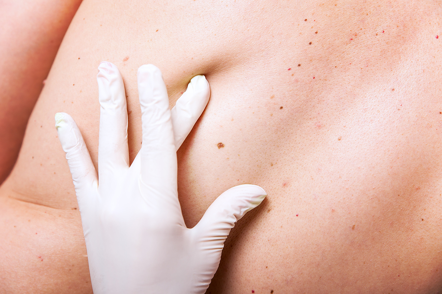 Καρκίνος του Δέρματος: Τί πρέπει να γνωρίζω και πώς να προστατευθώ;