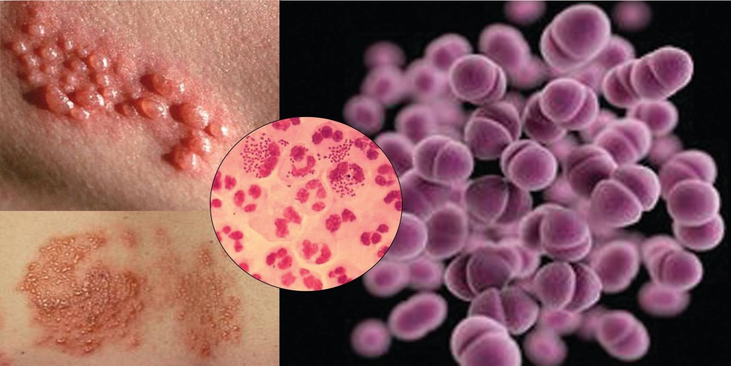 Συνεχή αύξηση παρουσιάζει η γονόρροια στην Ευρώπη