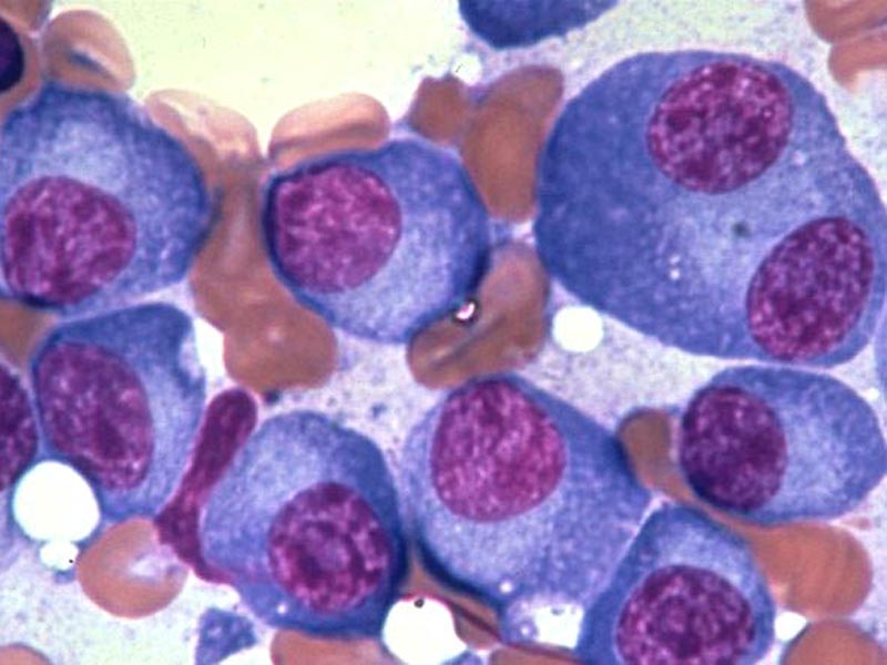 Θετική γνωμοδότηση για την ιξαζομίμπη στη θεραπεία του Πολλαπλού Μυελώματος