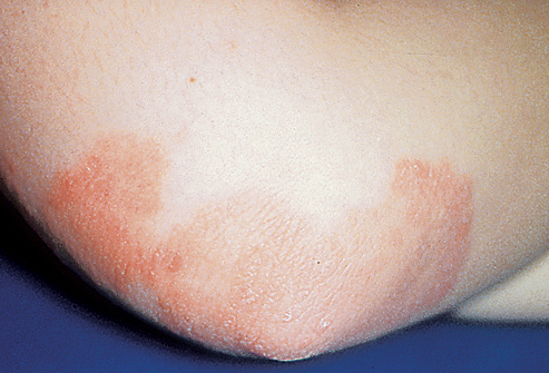 Ενημερωτική εκδήλωση για την ψωρίαση διοργανώνει το Σωματείο «ΚΑΛΥΨΩ»