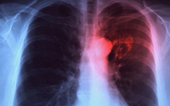 Επανεμφάνιση φυματίωσης στην Ελλάδα λόγω πτώσης βιωτικού επιπέδου