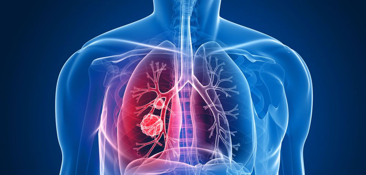 FDA: Έγκριση του pembrolizumab ως αρχική θεραπεία στον καρκίνο πνεύμονα