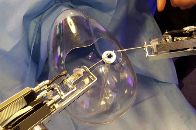 Χειρουργικό ρομπότ για τα μάτια αφαιρεί επιδέξια τους καταρράκτες
