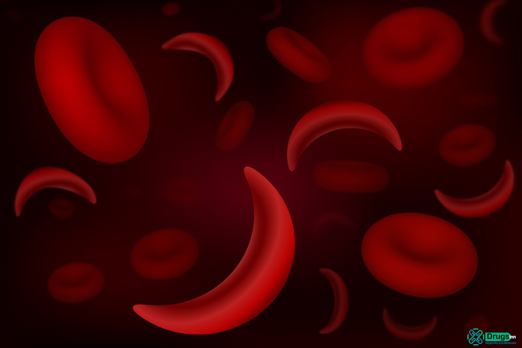 Γονιδιακή θεραπεία υπόσχεται ίαση της δρεπανοκυτταρικής αναιμίας