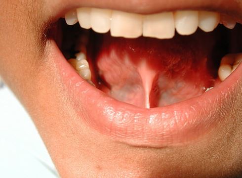 Όλο και νεότερα άτομα προσβάλλει ο καρκίνος της στοματικής κοιλότητας