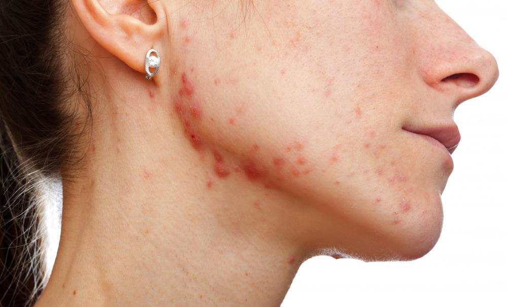 Μελέτη απαντά στο ερώτημα γιατί επανεμφανίζεται η ακμή