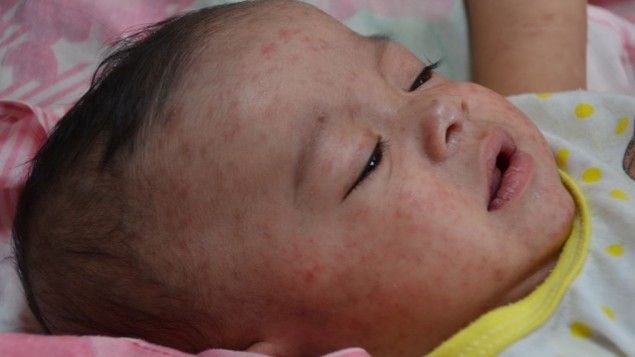 Επιδημία ιλαράς σε ορθόδοξους Εβραίους που αρνούνται τον εμβολιασμό