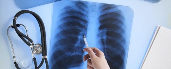 Γενετικός «προαγωγός» παίζει ρόλο στο αδενοκαρκίνωμα του πνεύμονα