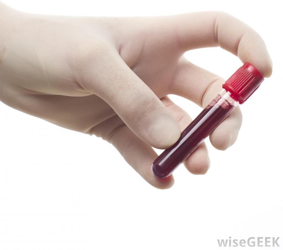 Εξέταση αίματος διακρίνει τη νόσο Πάρκινσον από τα άτυπα παρκινσονικά σύνδρομα