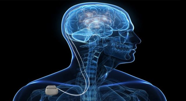 Βηματοδότης στον εγκέφαλο για τη νευρική ανορεξία;