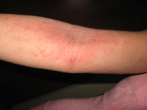 Σημαντική βελτίωση της μέτριας έως σοβαρής ατοπικής δερματίτιδας με dupilumab