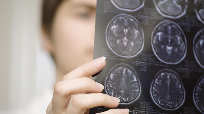 Μελέτη αποκαλύπτει τι συμβαίνει στον εφηβικό εγκέφαλο