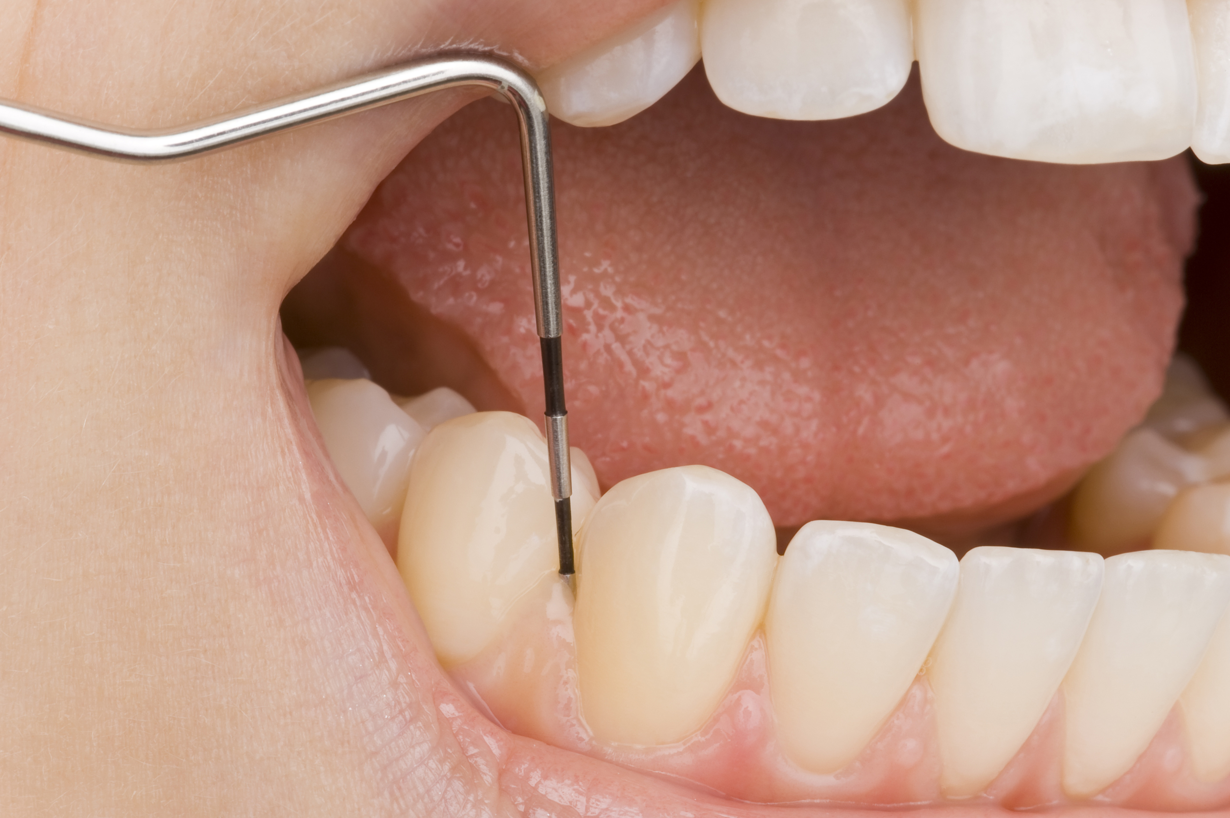 Περιοδοντική νόσος και απώλεια δοντιών σχετίζονται με πρόωρο θάνατο