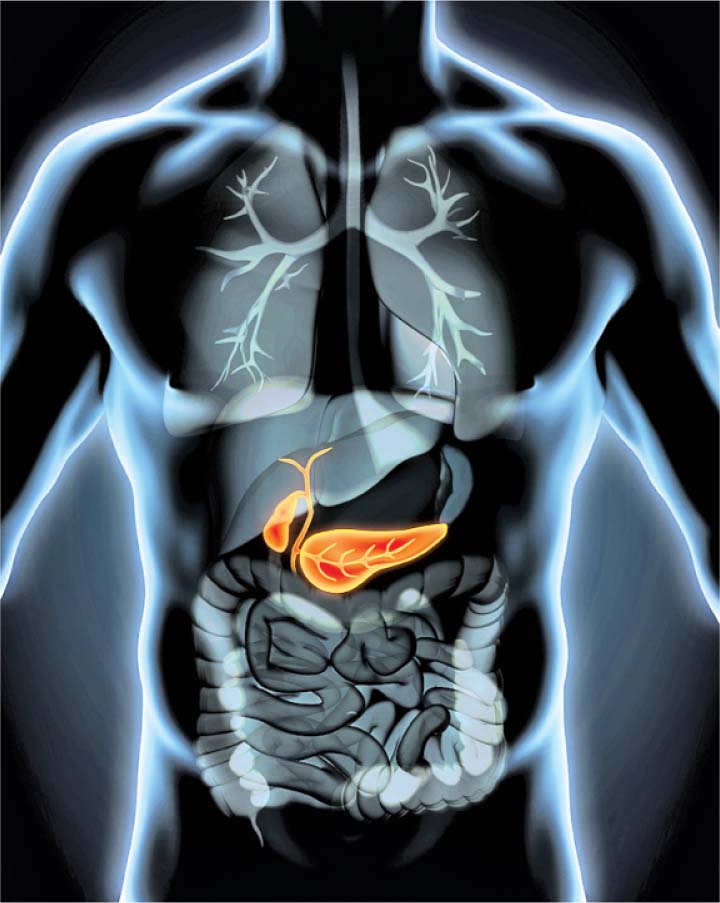 H κολεκτομή αυξάνει τον κίνδυνο χολολιθίασης στα άτομα με ελκώδη κολίτιδα
