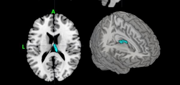 Υπολογιστικό σύστημα μπορεί να διαγνώσει την κατάθλιψη