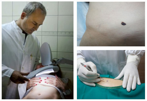 Αναγνωρίστε εγκαίρως μια δερματική βλάβη και γλιτώστε από το μελάνωμα