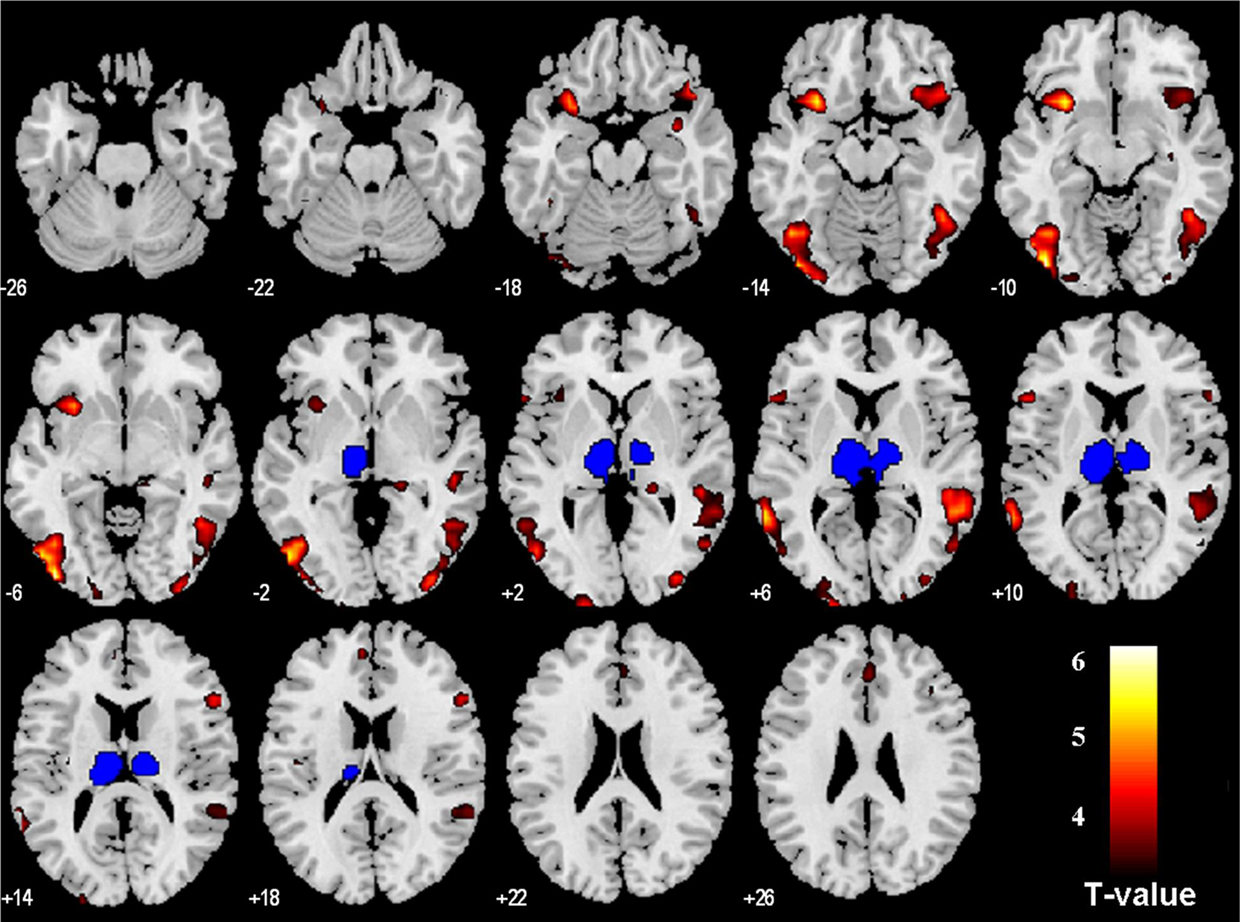 Εγκεφαλικές αλλοιώσεις προκαλεί ο συνδυασμός παχυσαρκίας και διαβήτη