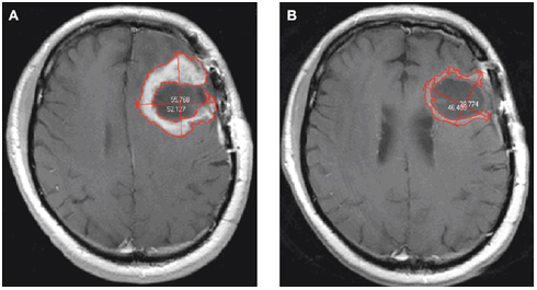 Διαβήτης και υψηλό σάκχαρο αποτρέπουν την εκδήλωση εγκεφαλικού όγκου