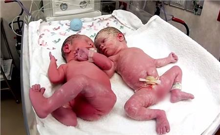 Βίντεο: Όταν τα δίδυμα «συναντιούνται» για πρώτη φορά