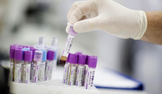 Μελέτη επιβεβαιώνει την αξία του τεστ PSA στη θεραπεία του καρκίνου προστάτη