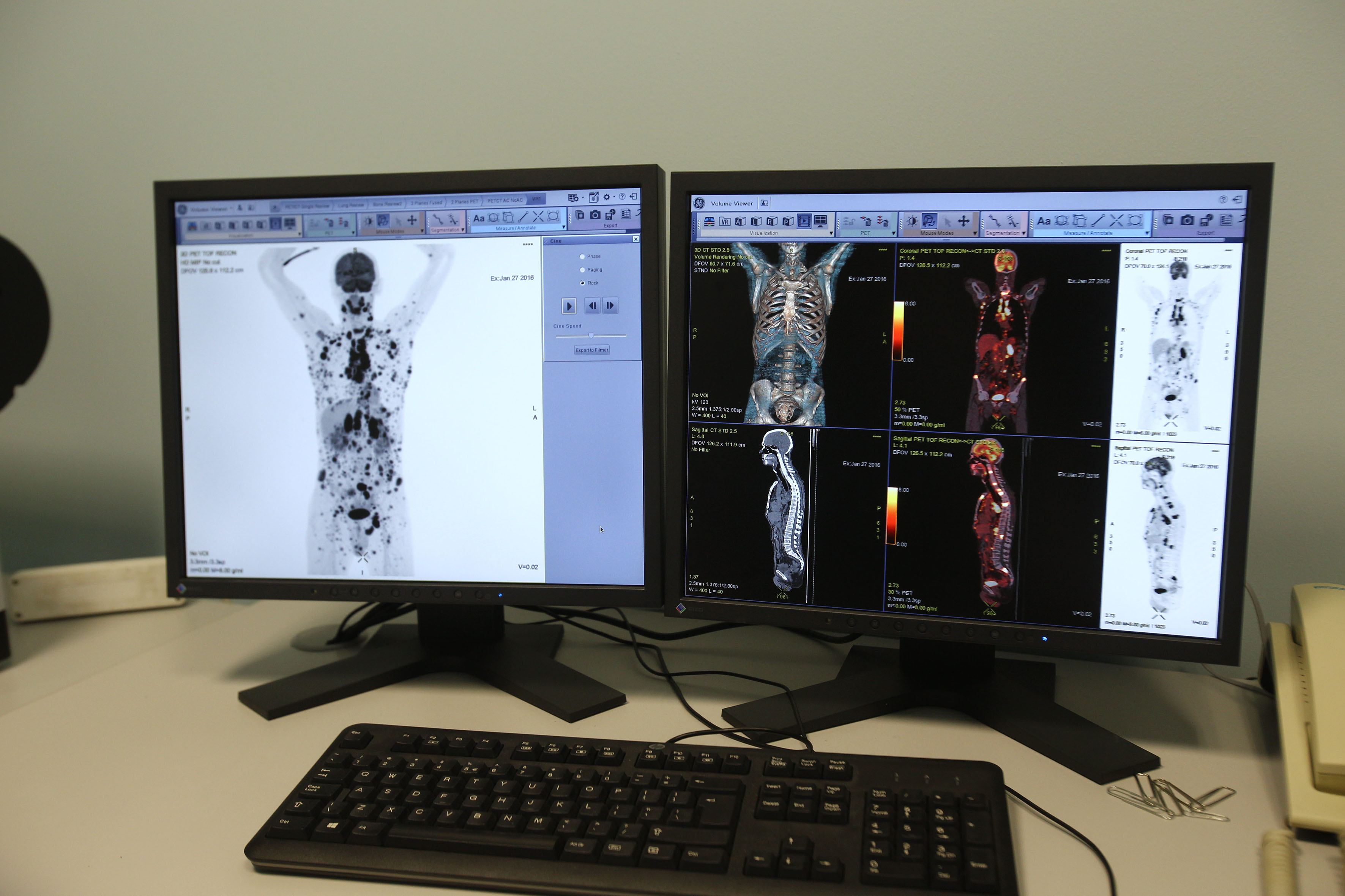 ΠΟΕΔΗΝ: Χιλιάδες καρκινοπαθείς στερούνται πρόσβασης σε σωτήρια εξέταση