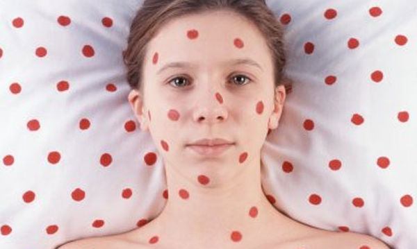 Ανησυχία από την ανοδική πορεία της ιλαράς – 30 κρούσματα σε μια βδομάδα