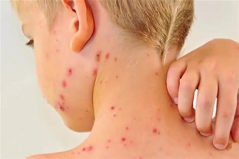 Facebook Live από το in.gr για την έξαρση της ιλαράς στην Ελλάδα