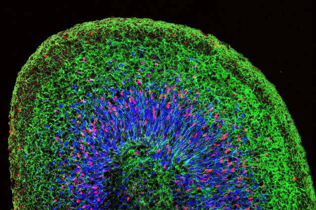 Εργαστηριακοί μίνι εγκέφαλοι αλλάζουν τη μελέτη των νευρολογικών παθήσεων
